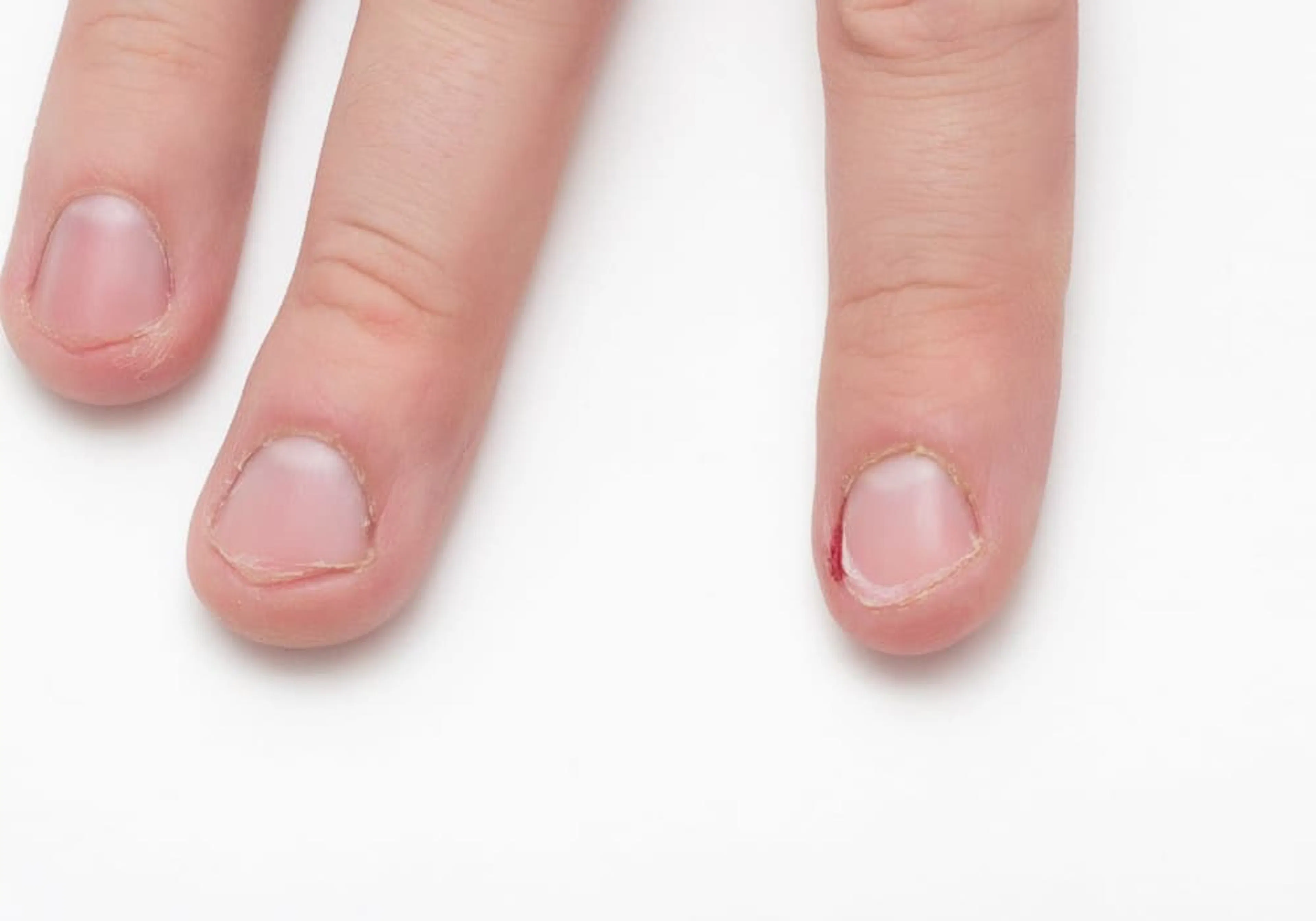 fingernagel med nageltrång