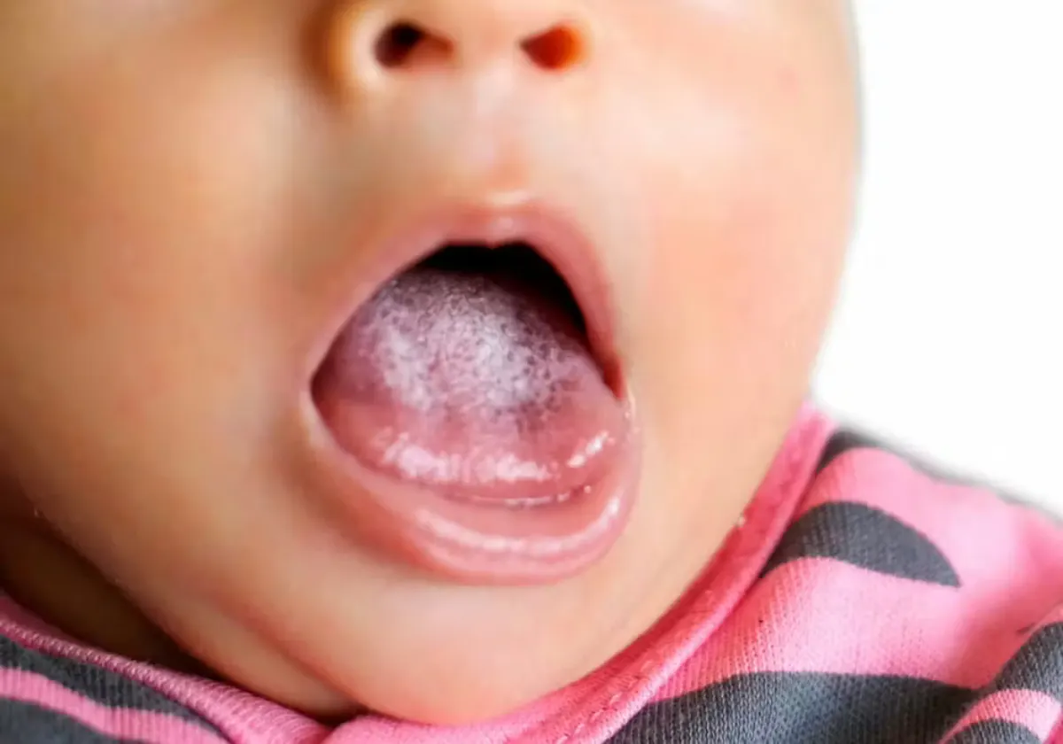 Bebis med vitbeläggning på tunga