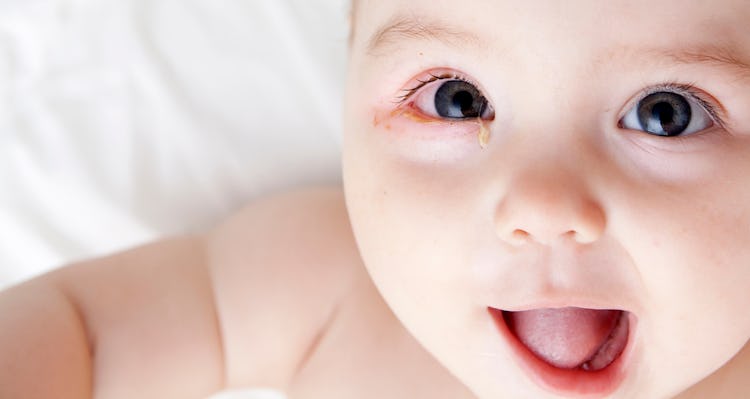 Vid en ögoninflammation hos barn kan ögonvitan bli röd, ögonen fuktiga och variga. 