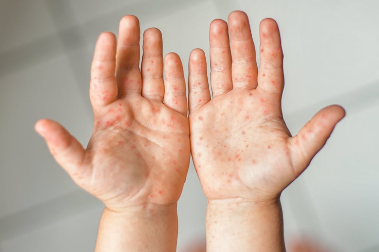 Blå Händer Och Fötter Barn Feber (blåa händer, händer fötter, medicinsk hjälp, barn feber, blåa händer fötter, Fötter Barn) Blå Händer Och Fötter Barn Feber