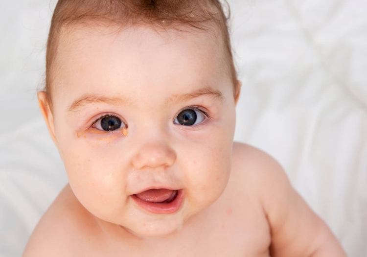 bebis med ögoninflammation