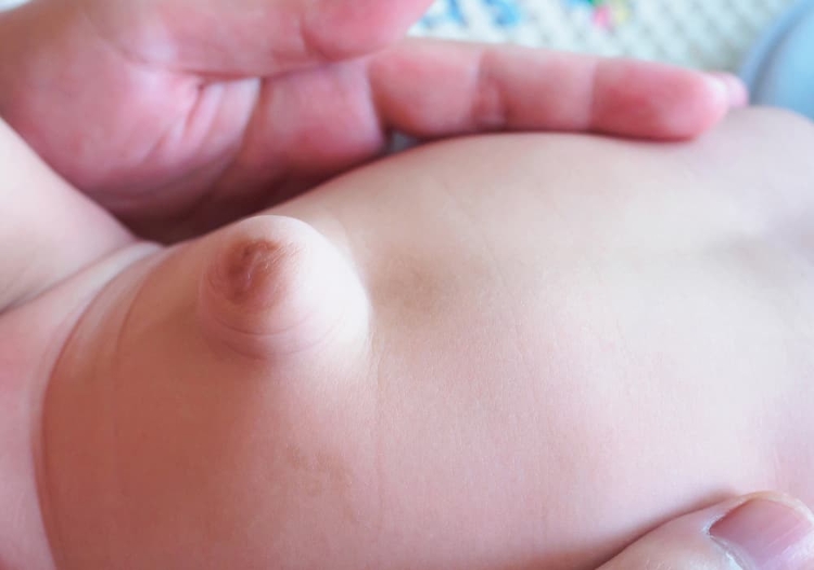 bebis med navelbråck