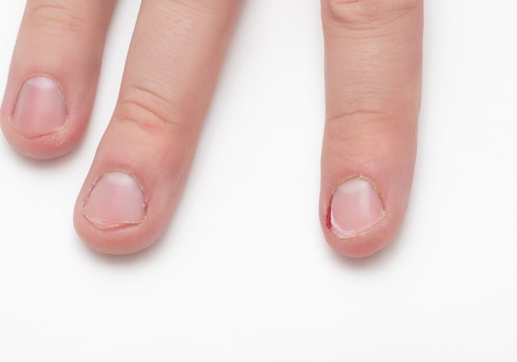 fingernagel med nageltrång