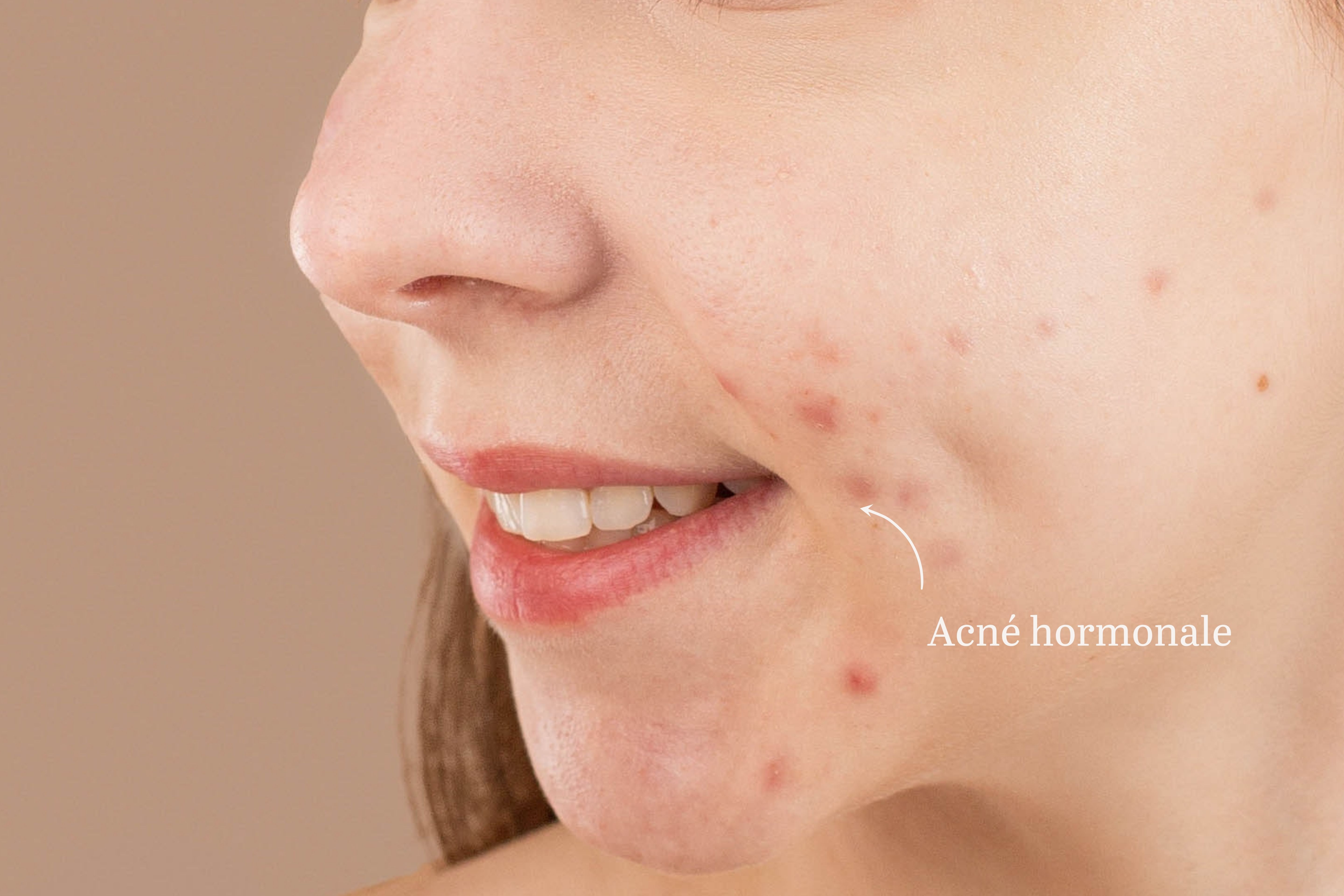 Comment reconnaître et lutter contre l'acné hormonale ? Laboté