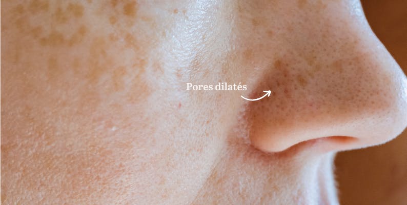 Points noirs sur le nez : comment s'en débarrasser : Femme