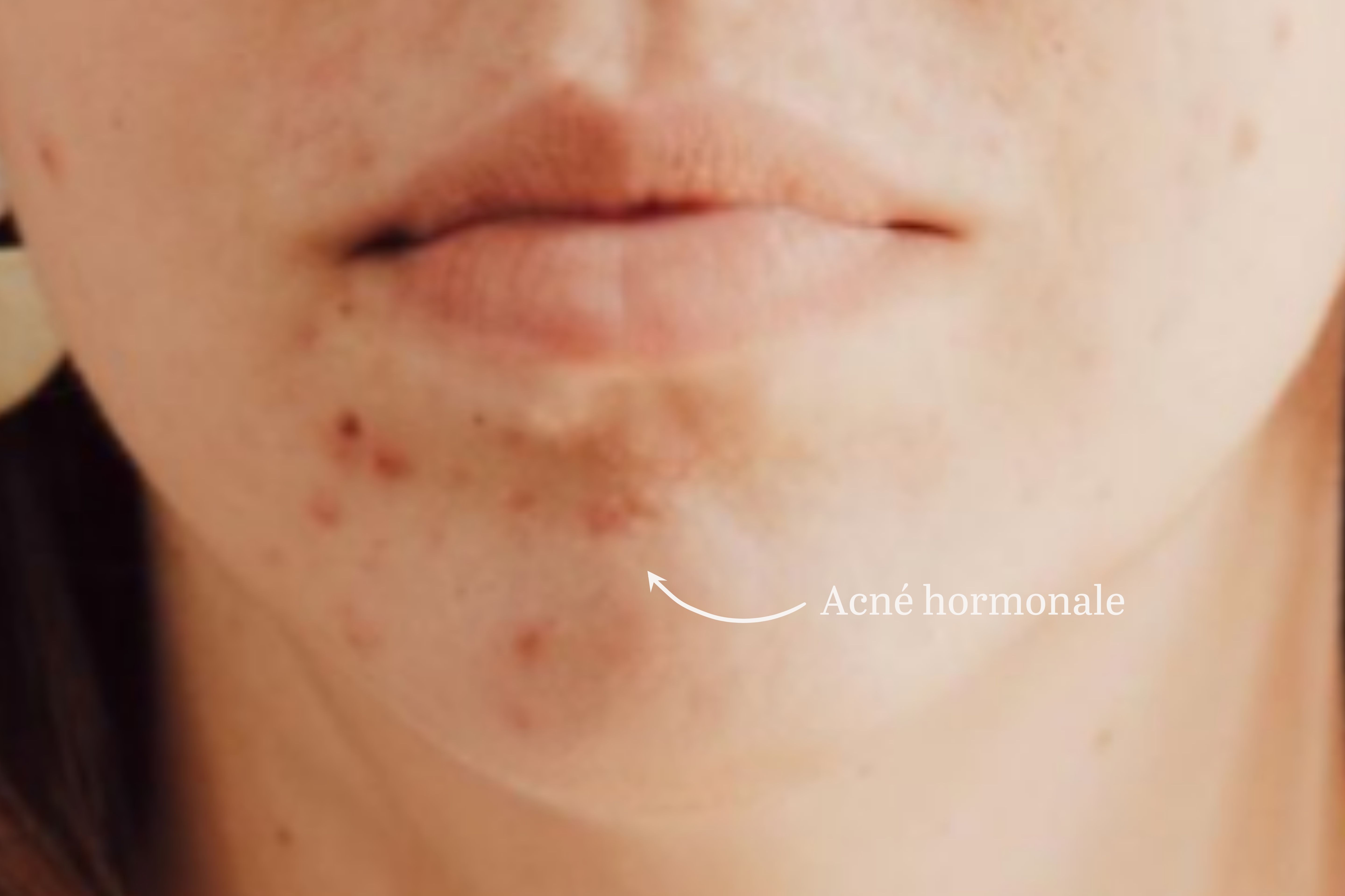 Comment reconnaître et lutter contre l'acné hormonale ? Laboté