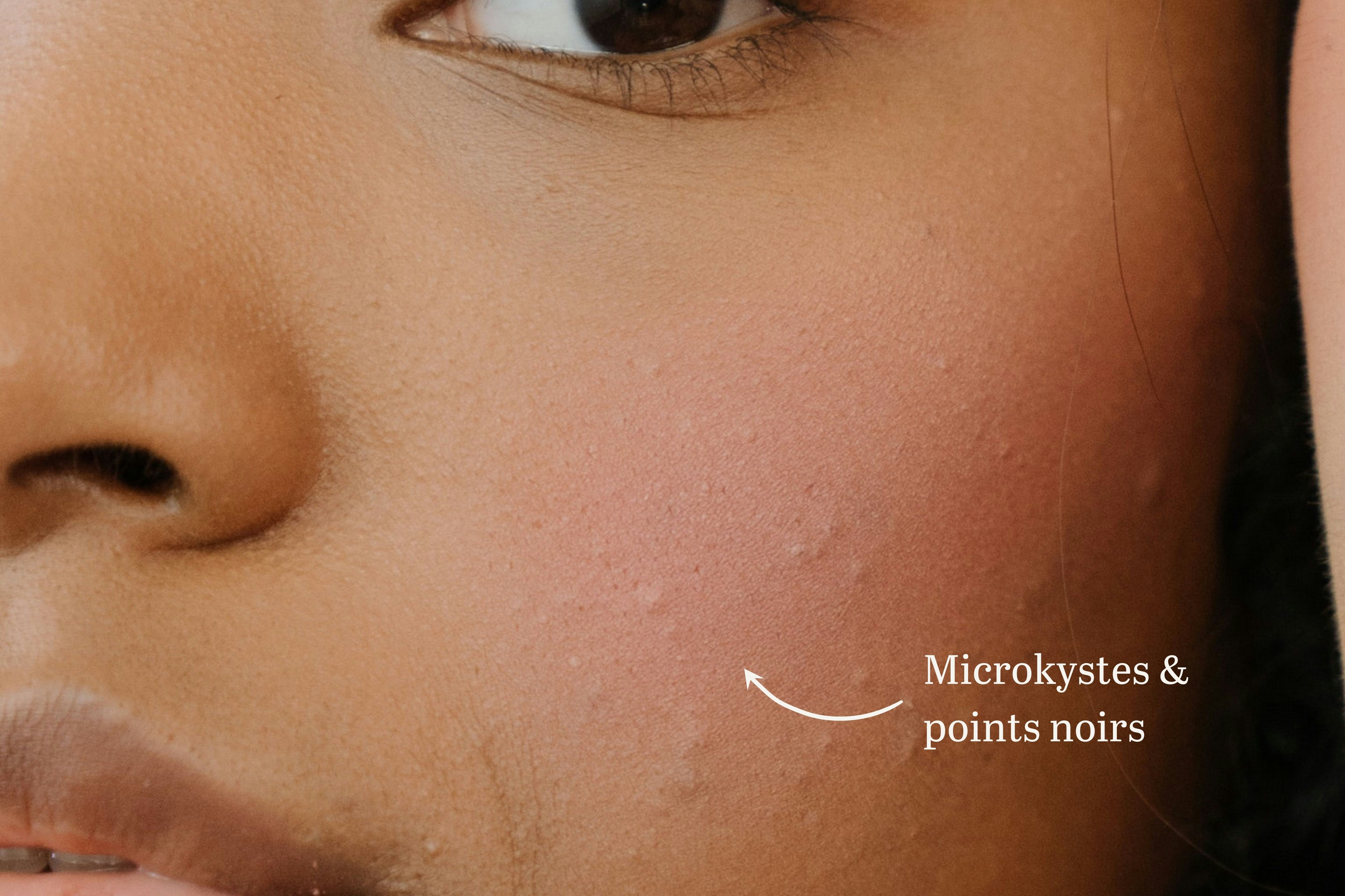 Comment reconnaître et lutter contre l'acné hormonale ? | Laboté