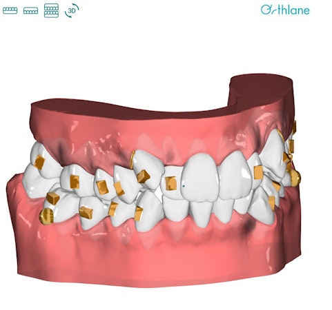 plan de traitement 3D alignement dentaire orthlane