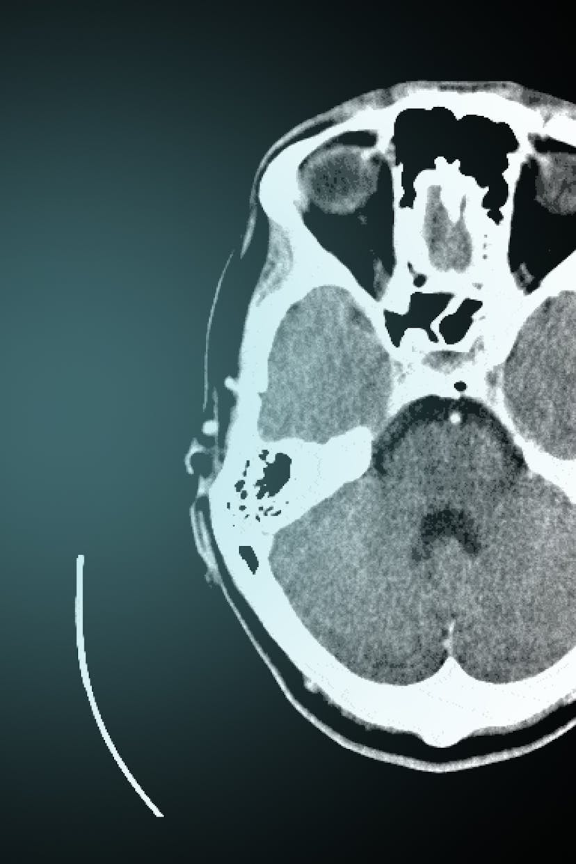 MRI scan of the brain