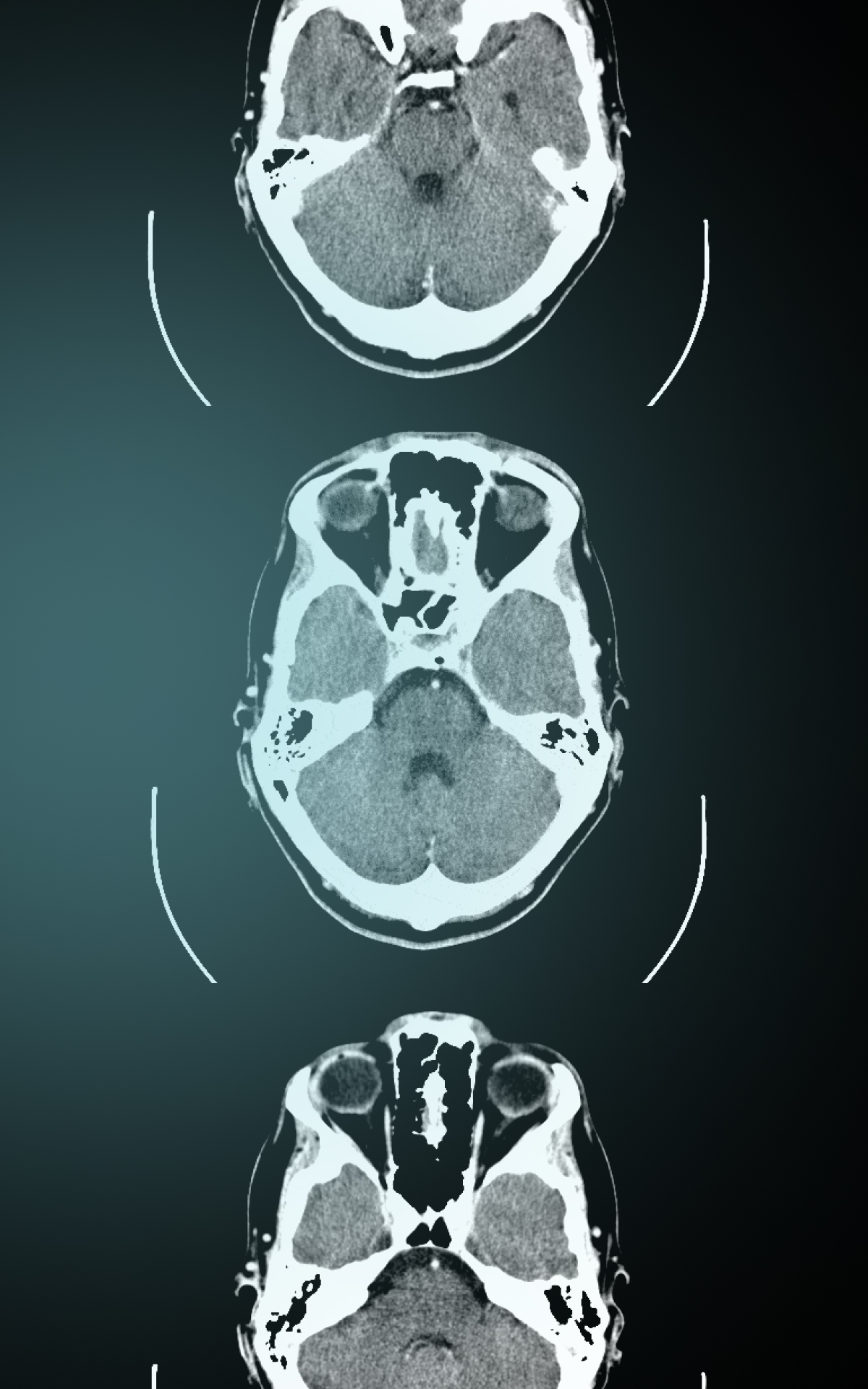 MRI scan of the brain