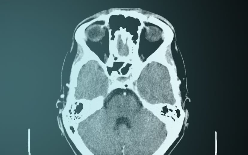 MRI scan of the brain