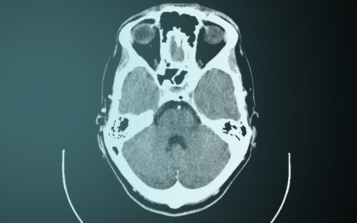 Series of three MRI scans of the brain at different cross-sections