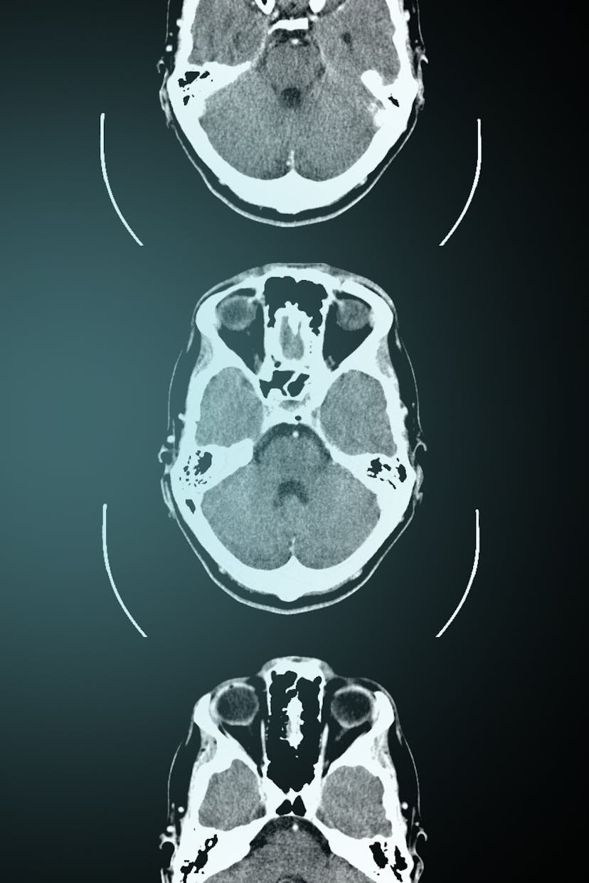 Series of three MRI scans of the brain at different cross-sections