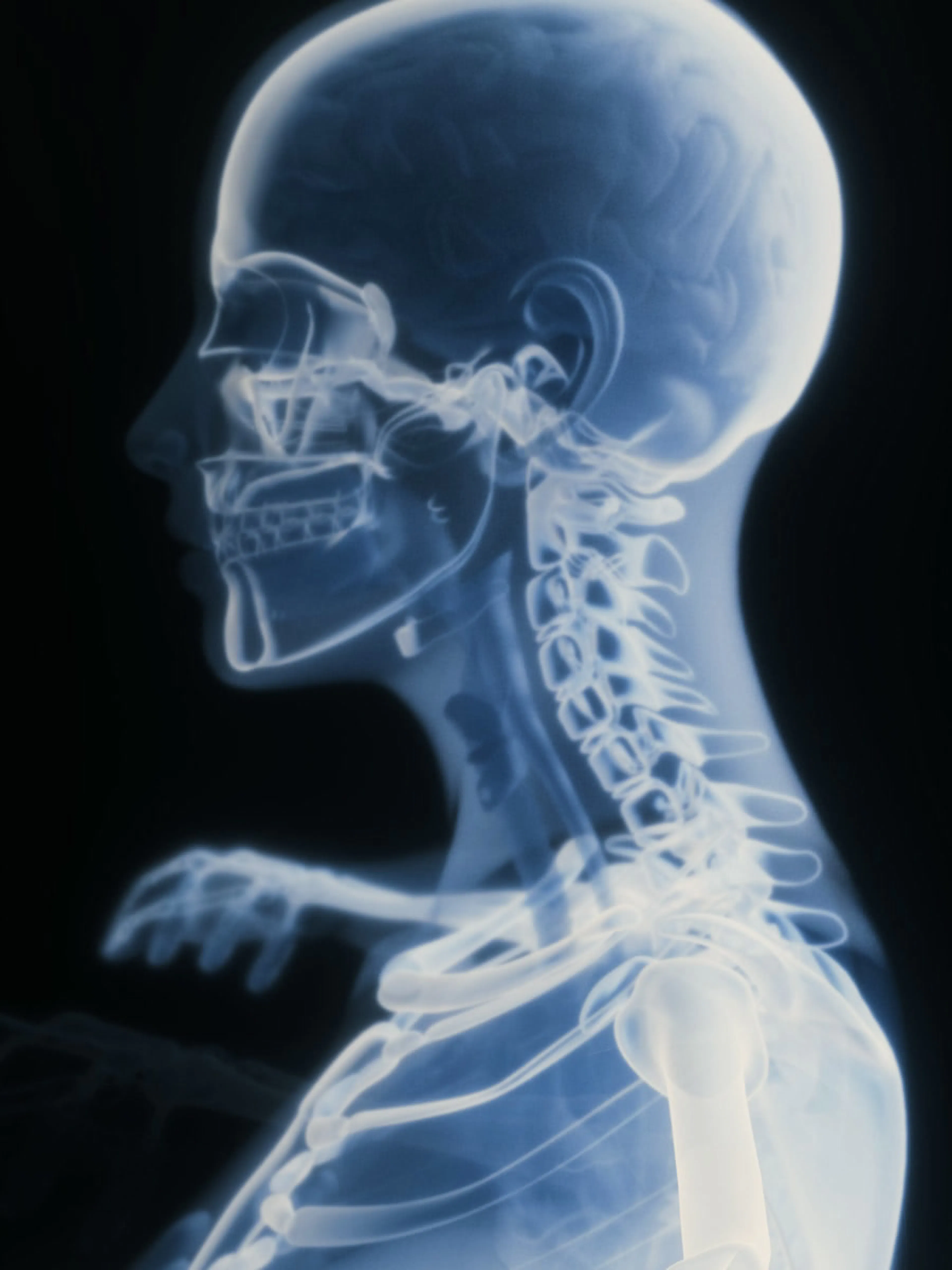 X-ray of the cervical spine in profile — Aurora Spine