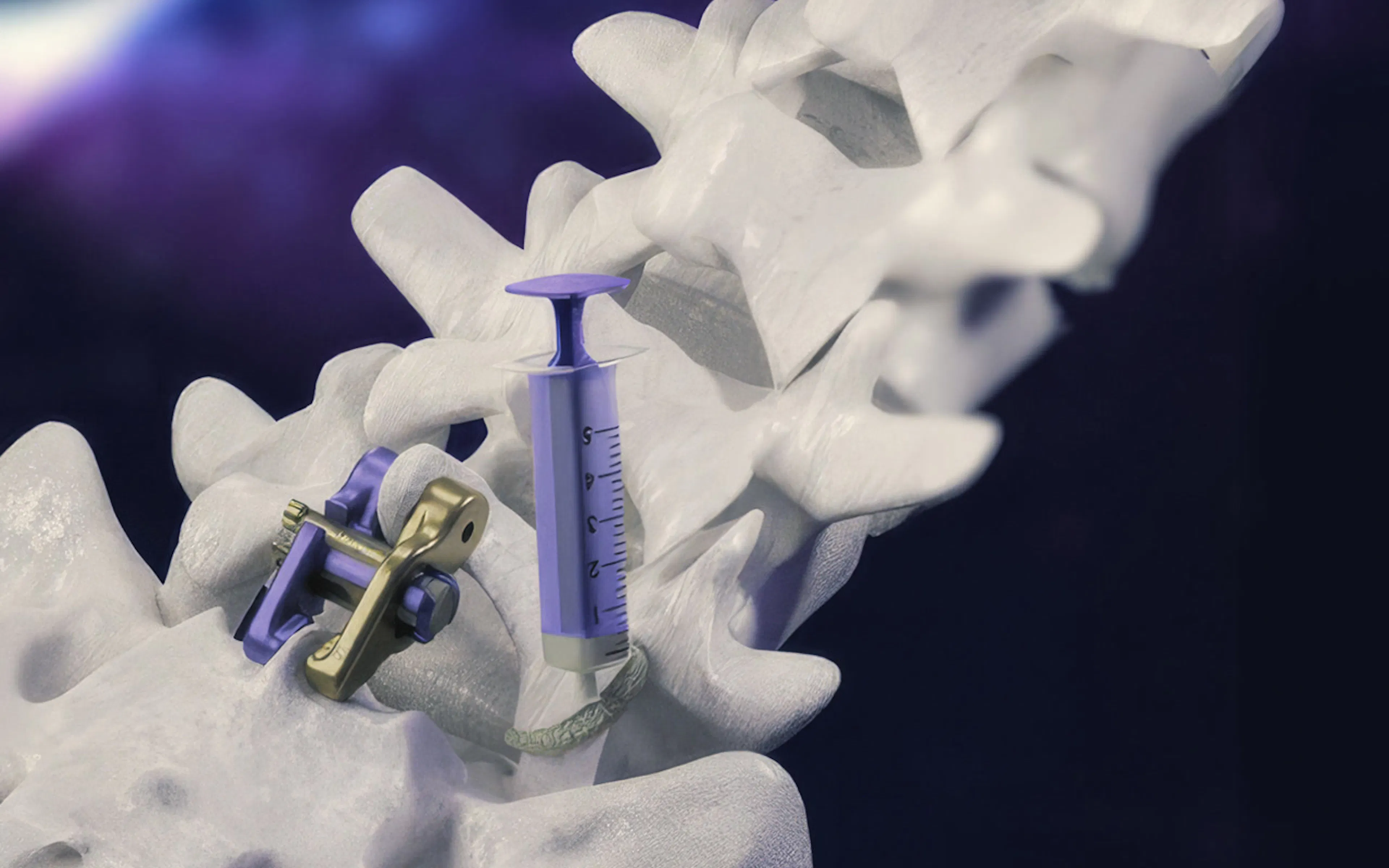 Aurora Spine interbody implant seated between vertebrae