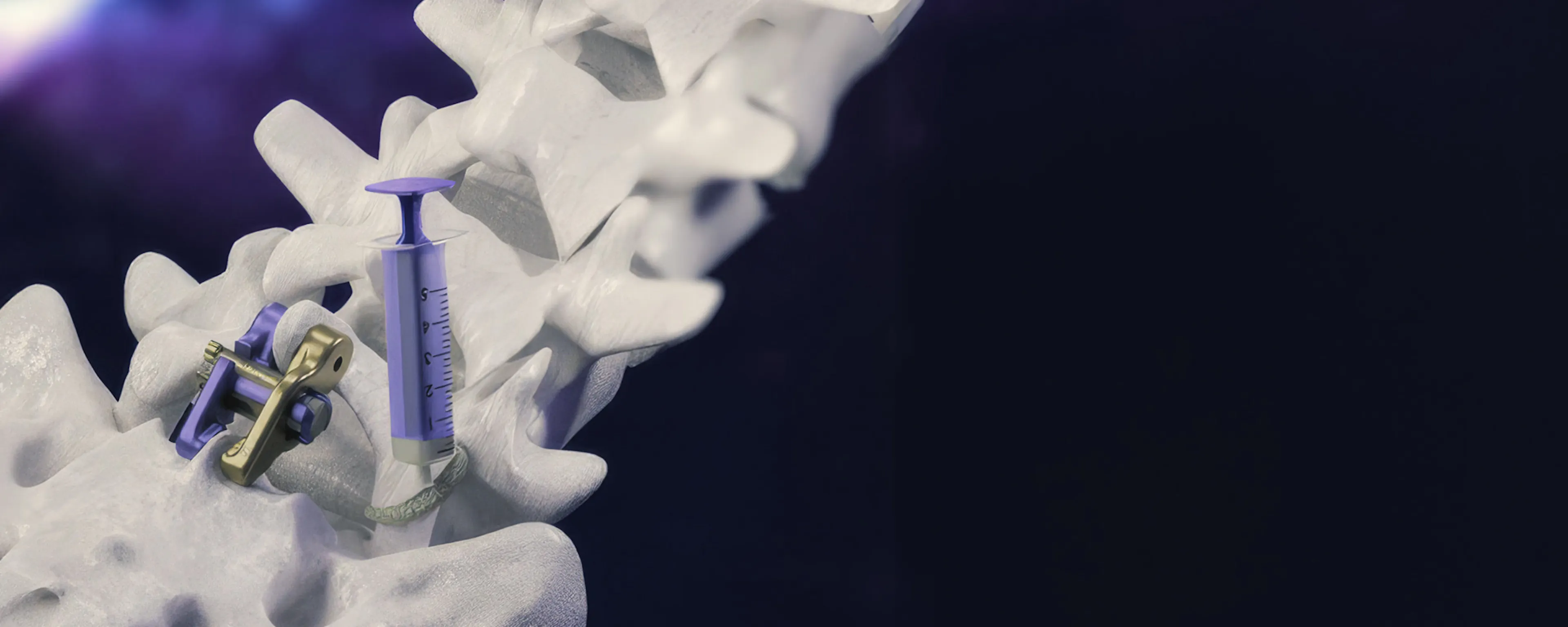 Aurora Spine interbody implant seated between vertebrae