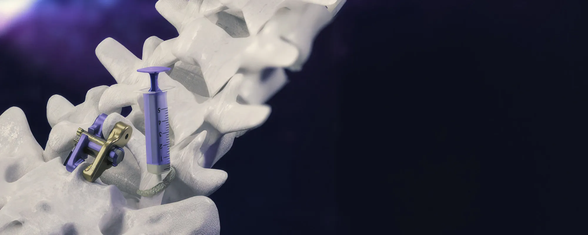 Aurora Spine interbody implant seated between vertebrae