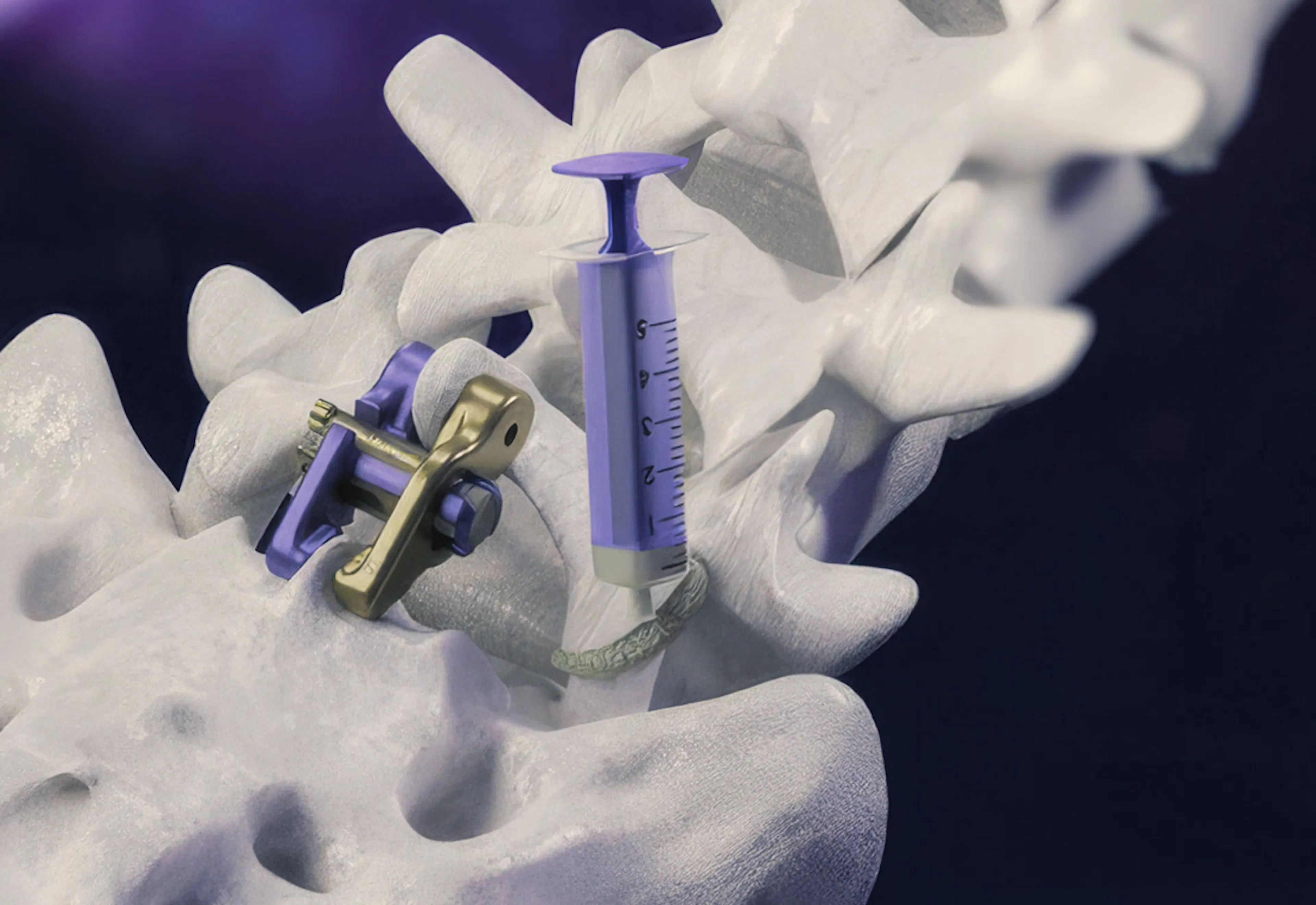 Aurora Spine interbody implant seated between vertebrae