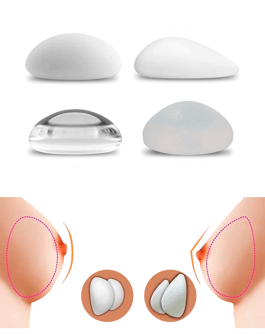 Breast Diagram