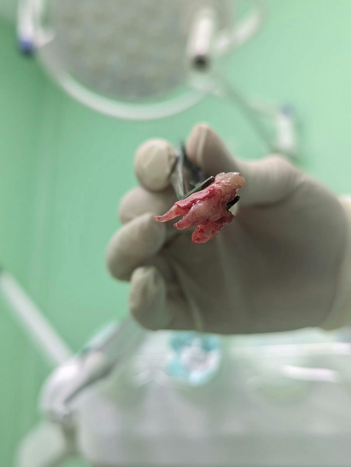 L'estrazione del dente: come prepararsi e comportarsi dopo l'intervento