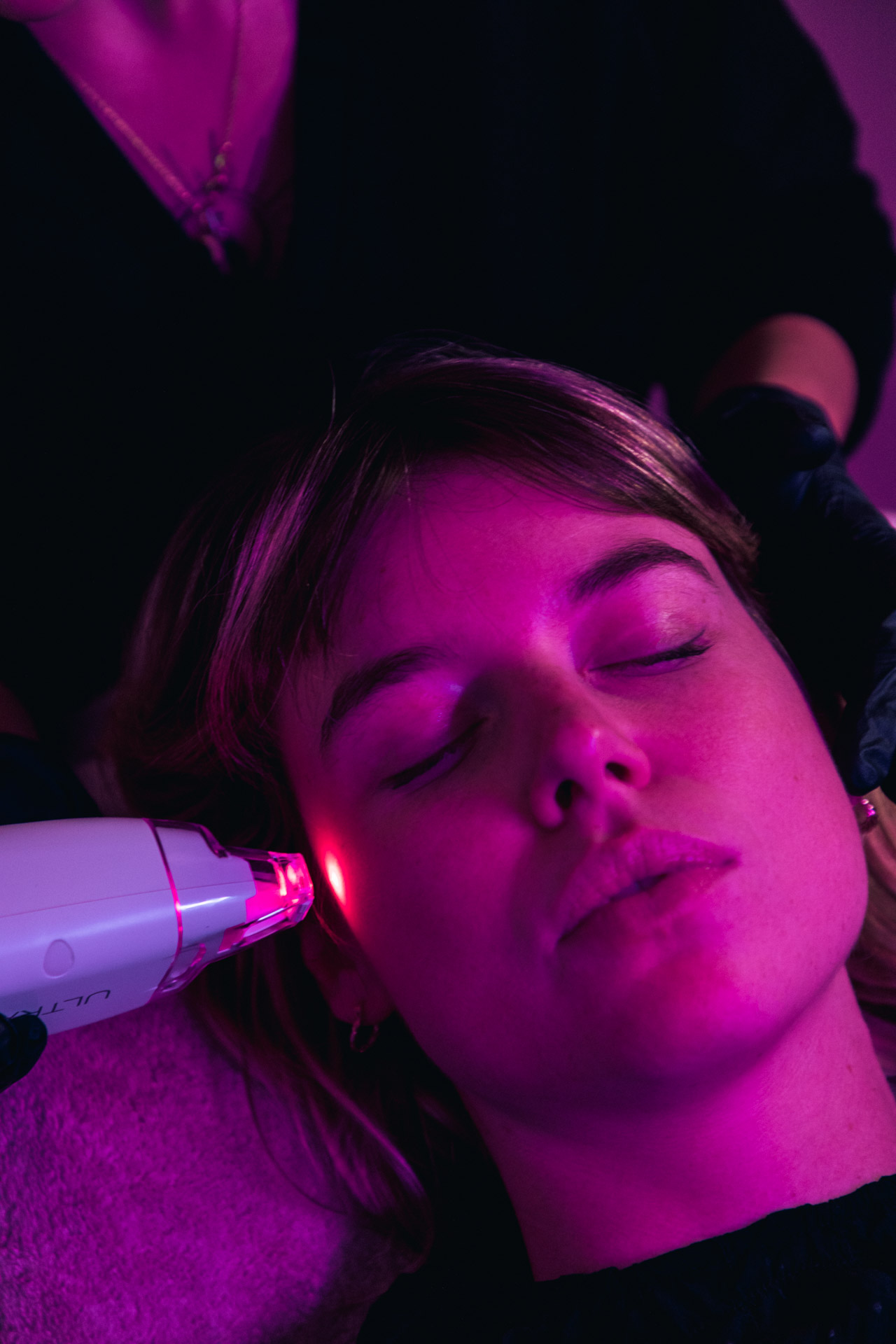 Résultat LaseMD Baby Face à Lyon chez Maison Yoko