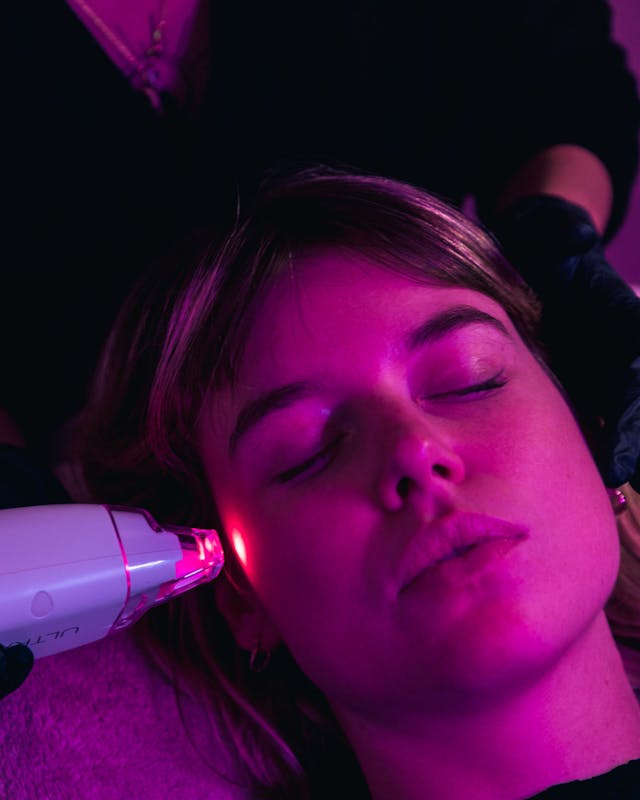 Résultat LaseMD Baby Face à Lyon chez Maison Yoko