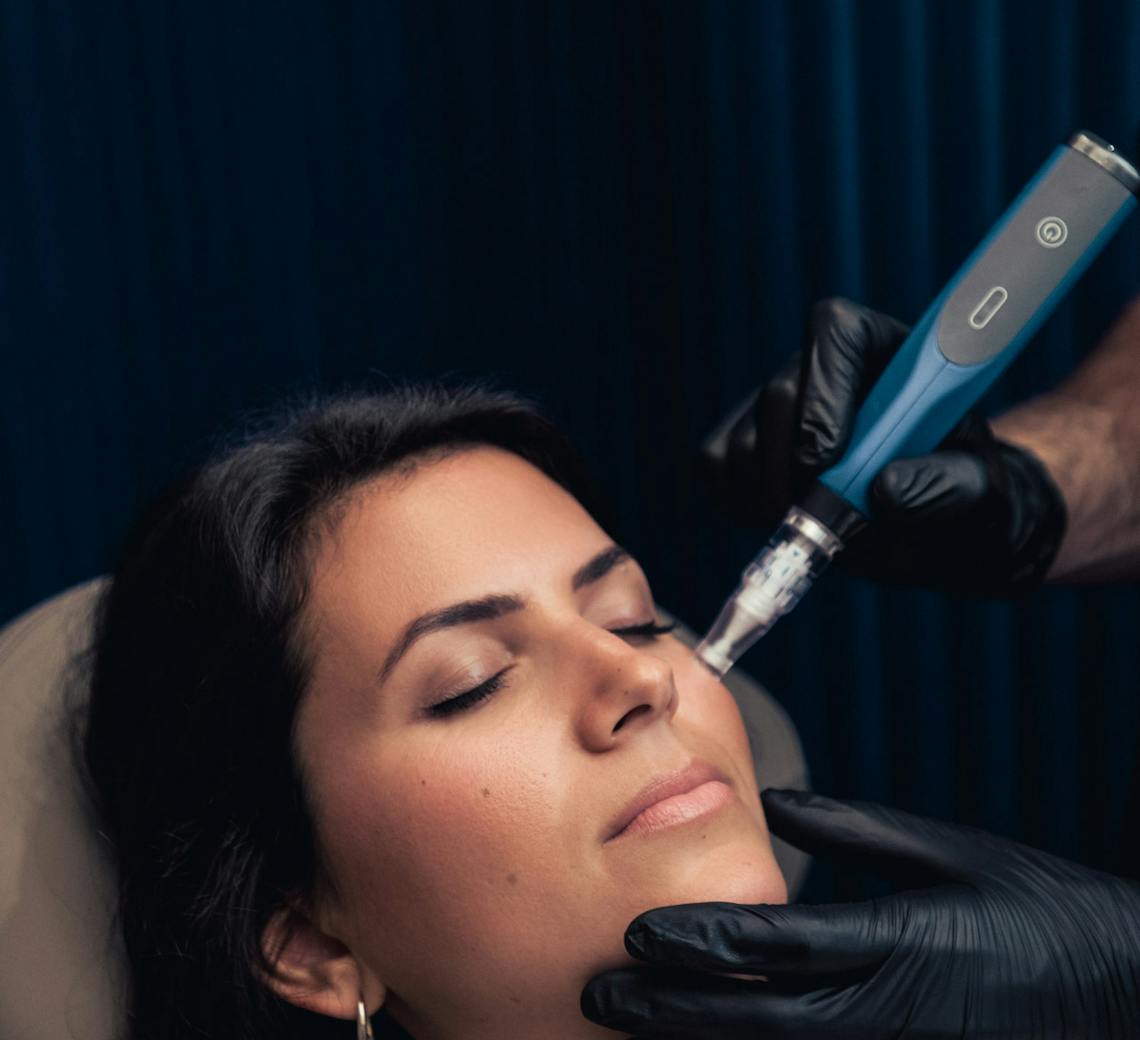 microneedling pour entretenir sa peau laser