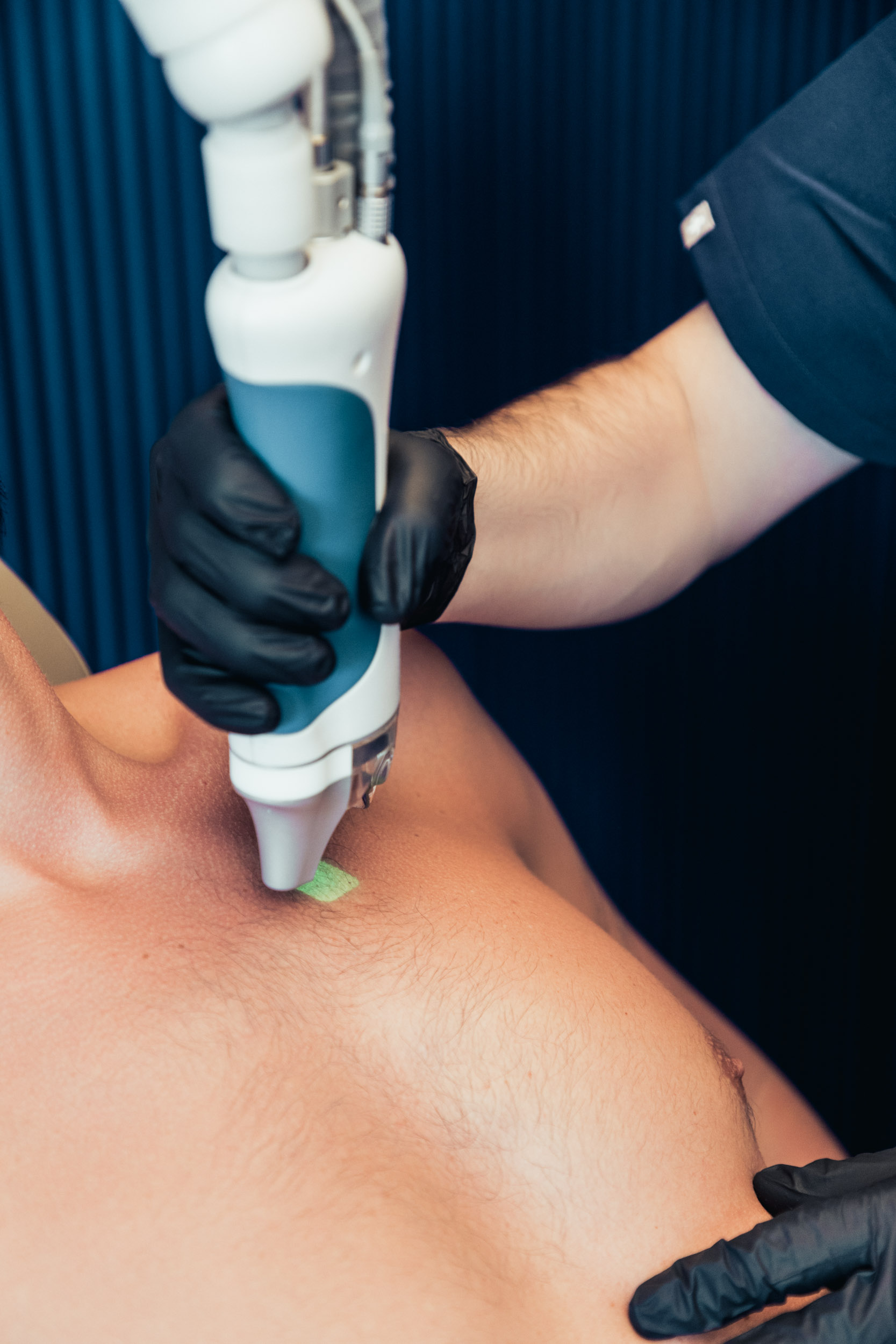 Epilation laser définitive homme à Lyon