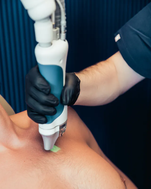 Epilation laser définitive homme à Lyon