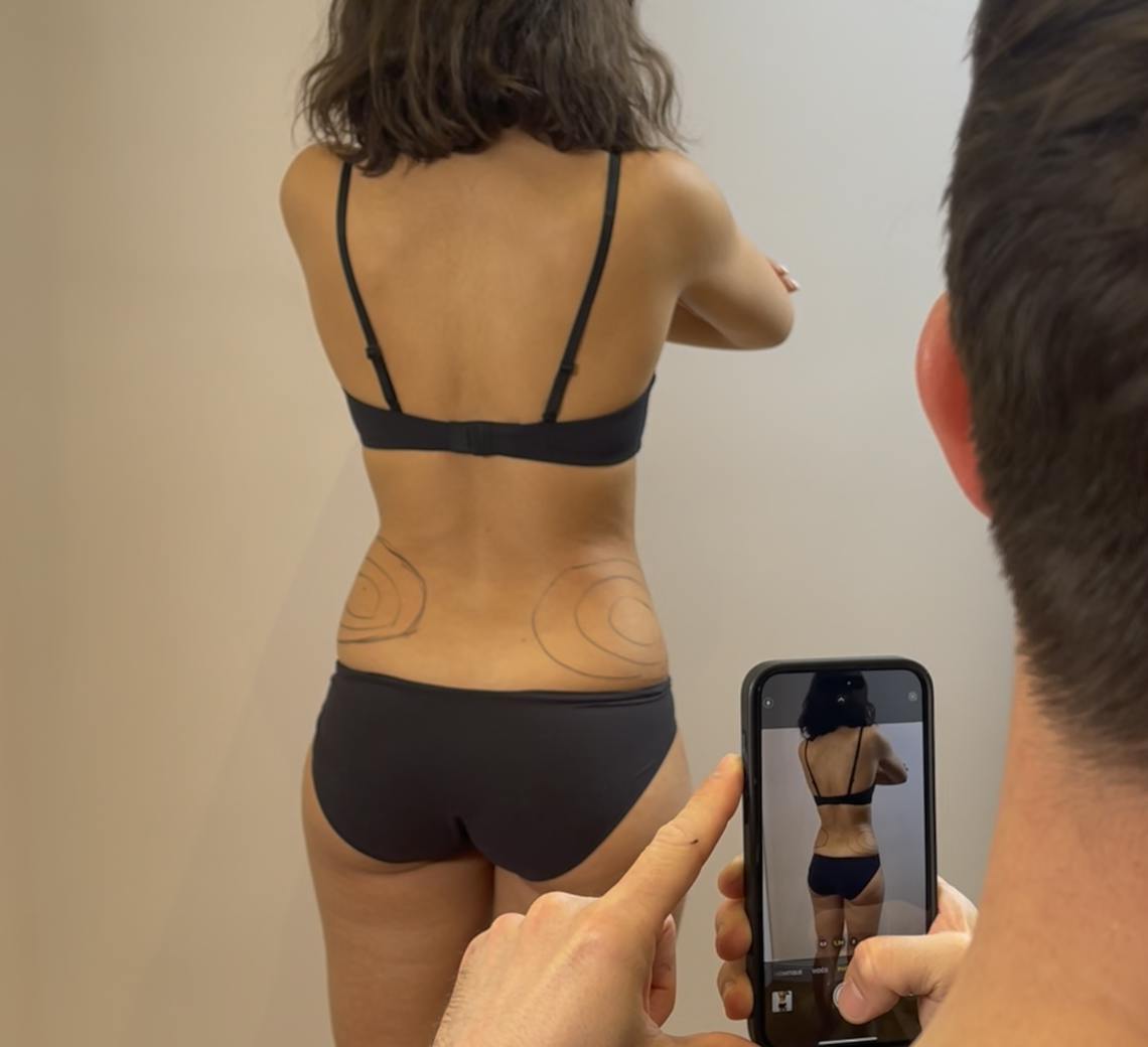 Coolsculpting : une marque avant tout