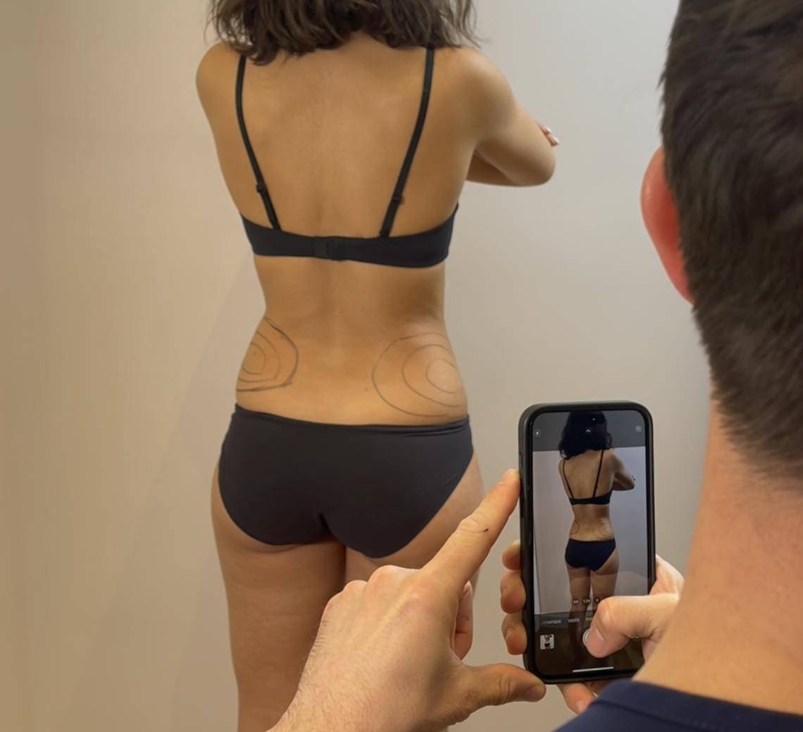 Les séances de cryolipolyse peuvent être vraiment efficaces pour réduire la couche graisseuse de certaines zones et rééquilibrer votre silhouette