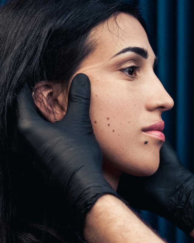 Retrouver une peau uniforme et lisse en traitant les lésions cutanées bénignes chez Maison Yoko à Lyon