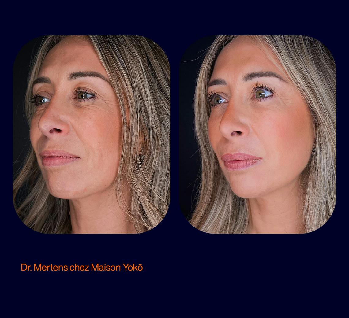Résultat avant après d'injections d'acide hyaluronique dans les sillons naseaugéniens, par le Dr Mertens à Lyon au centre de médecine esthétique et laser Maison Yoko