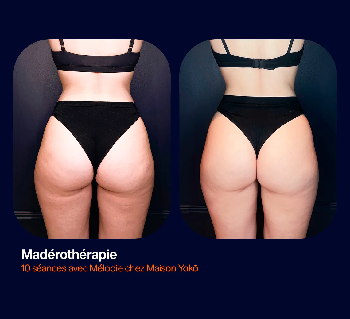 Résultats après 10 séance de madérothérapie, la cellulite est visible gommée. Chez Maison Yoko à Lyon