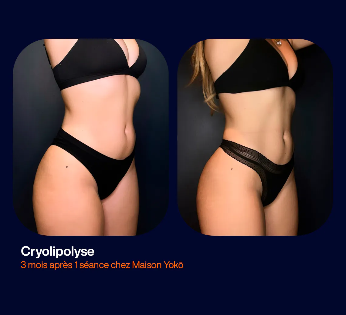Cryolipolyse avant après