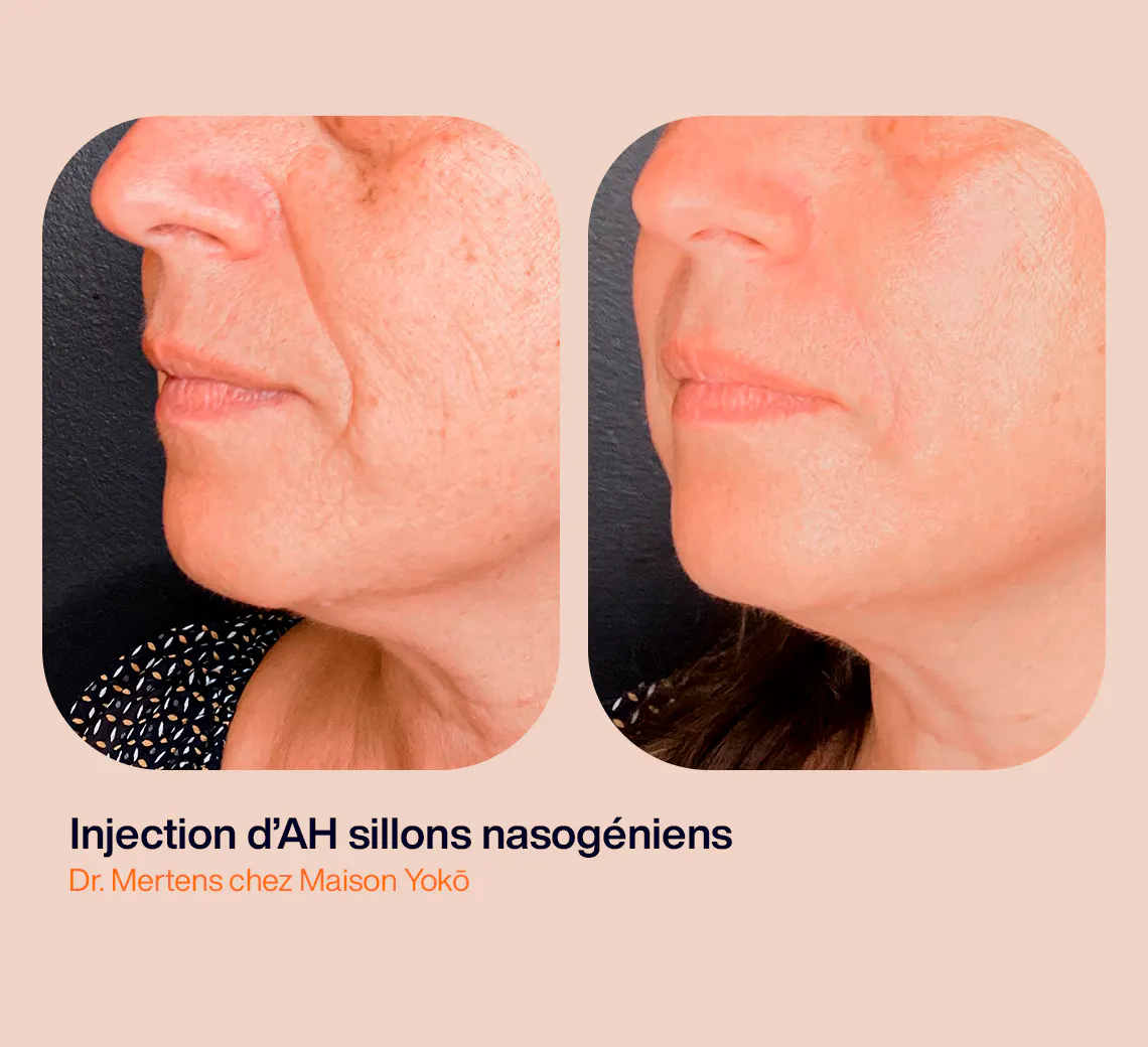 Résultats d'injections d'acide hyaluronique pour les sillons nasogéniens au Centre de Médecine Esthétique et Laser Maison Yoko à Lyon