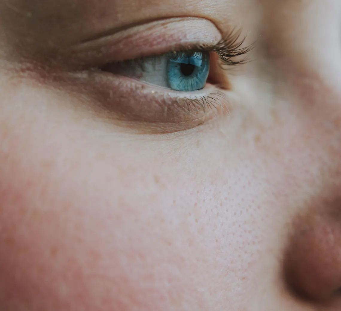 Stop aux rougeurs : tout savoir sur la rosacée et ses solutions
