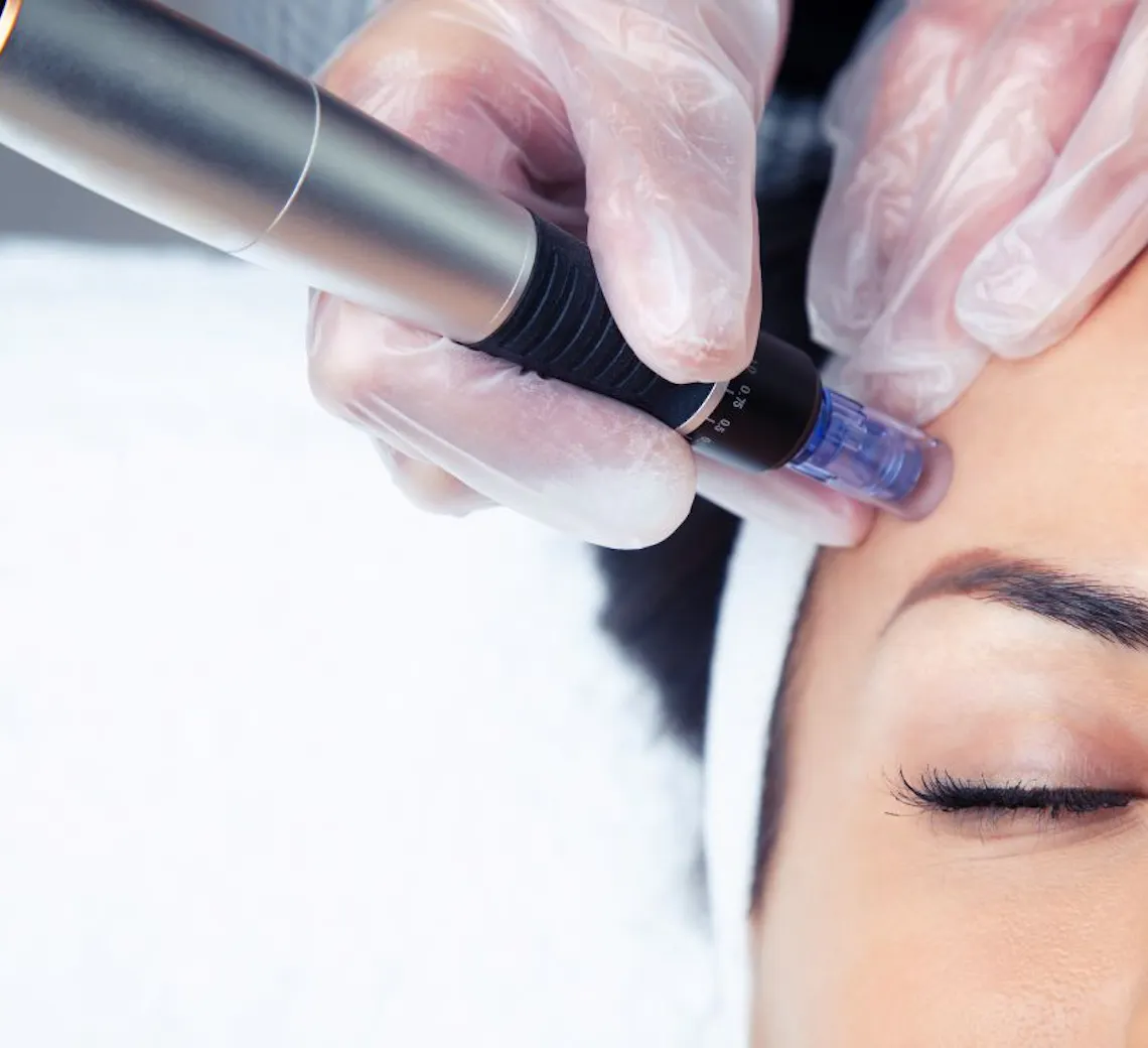 Soin skincare : microneedling