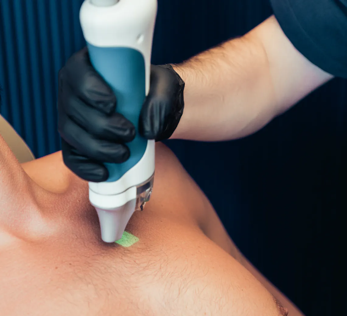 Epilation laser homme à lyon