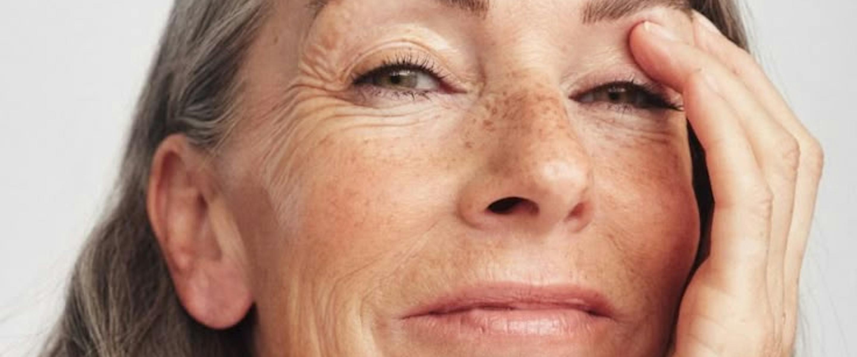 injection acide hyaluronique lyon pour les rides profondes