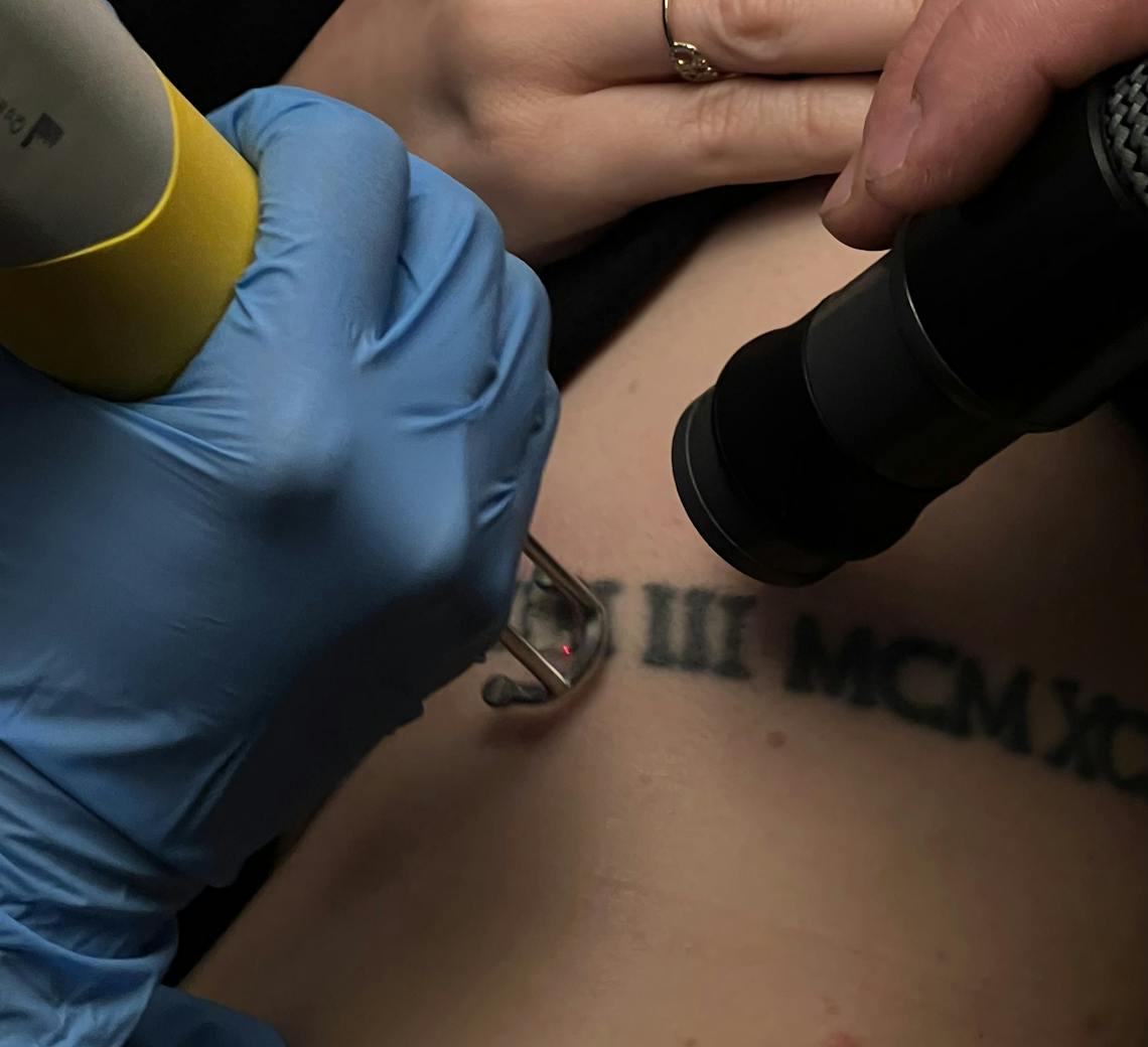 détatouage laser chez Maison Yokō