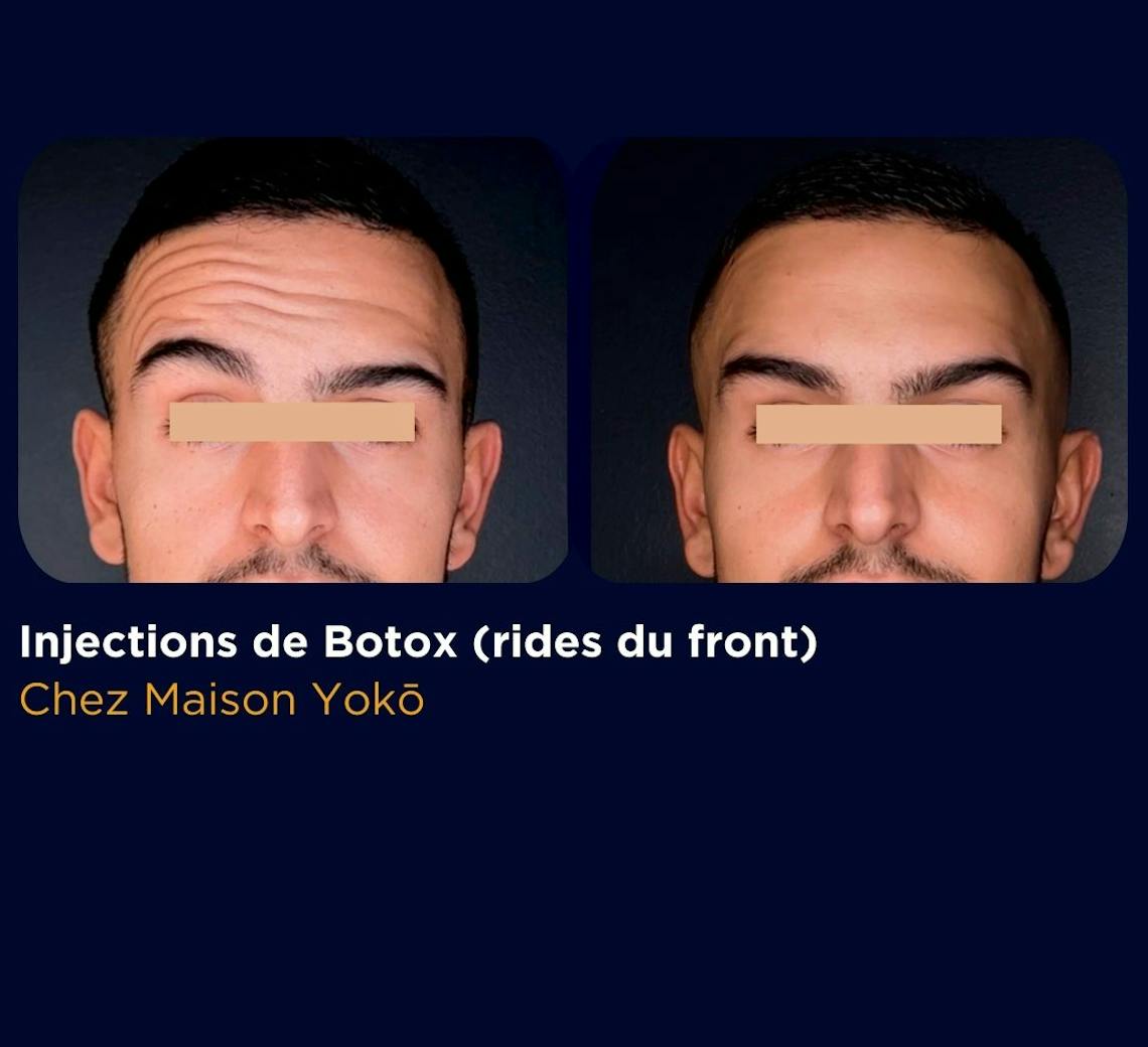 Avant/après injections de Botox ride du front chez Maison Yoko.
