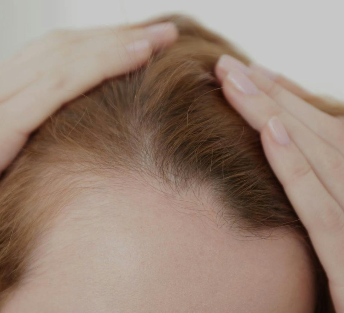 Chute de cheveux : les causes les plus fréquentes