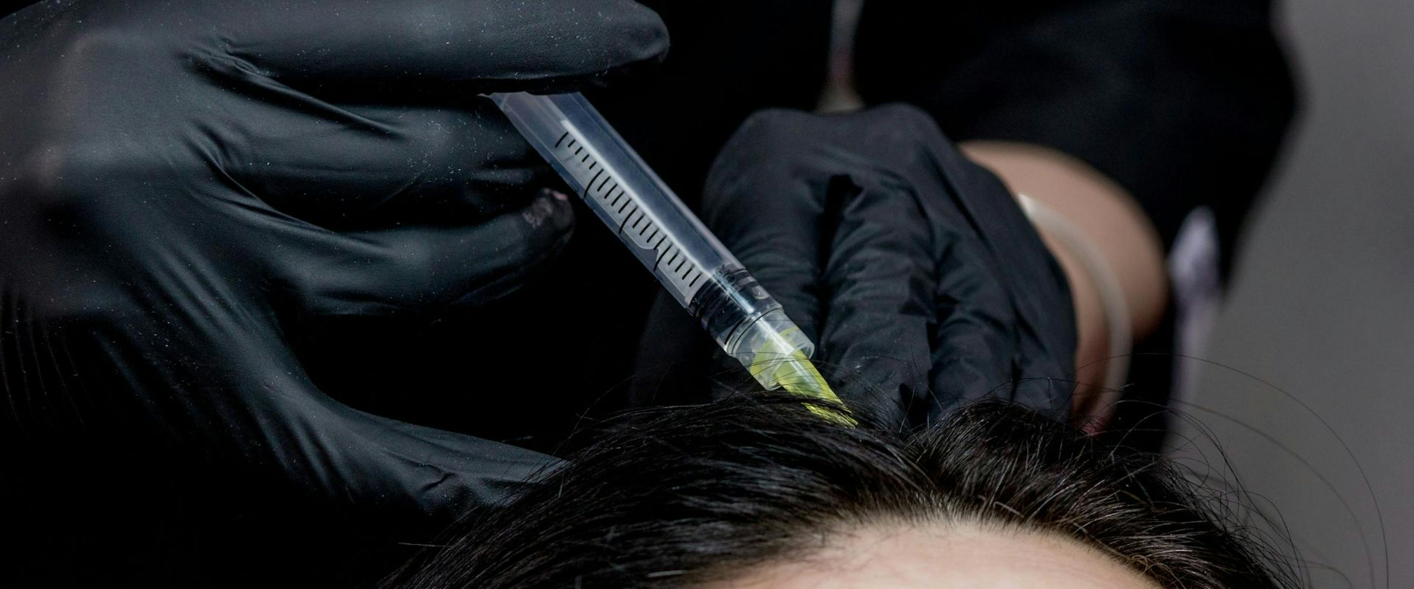 Praticien qui réalise une séance de mésothérapie capillaire dans le cuir chevelu d'une patiente.