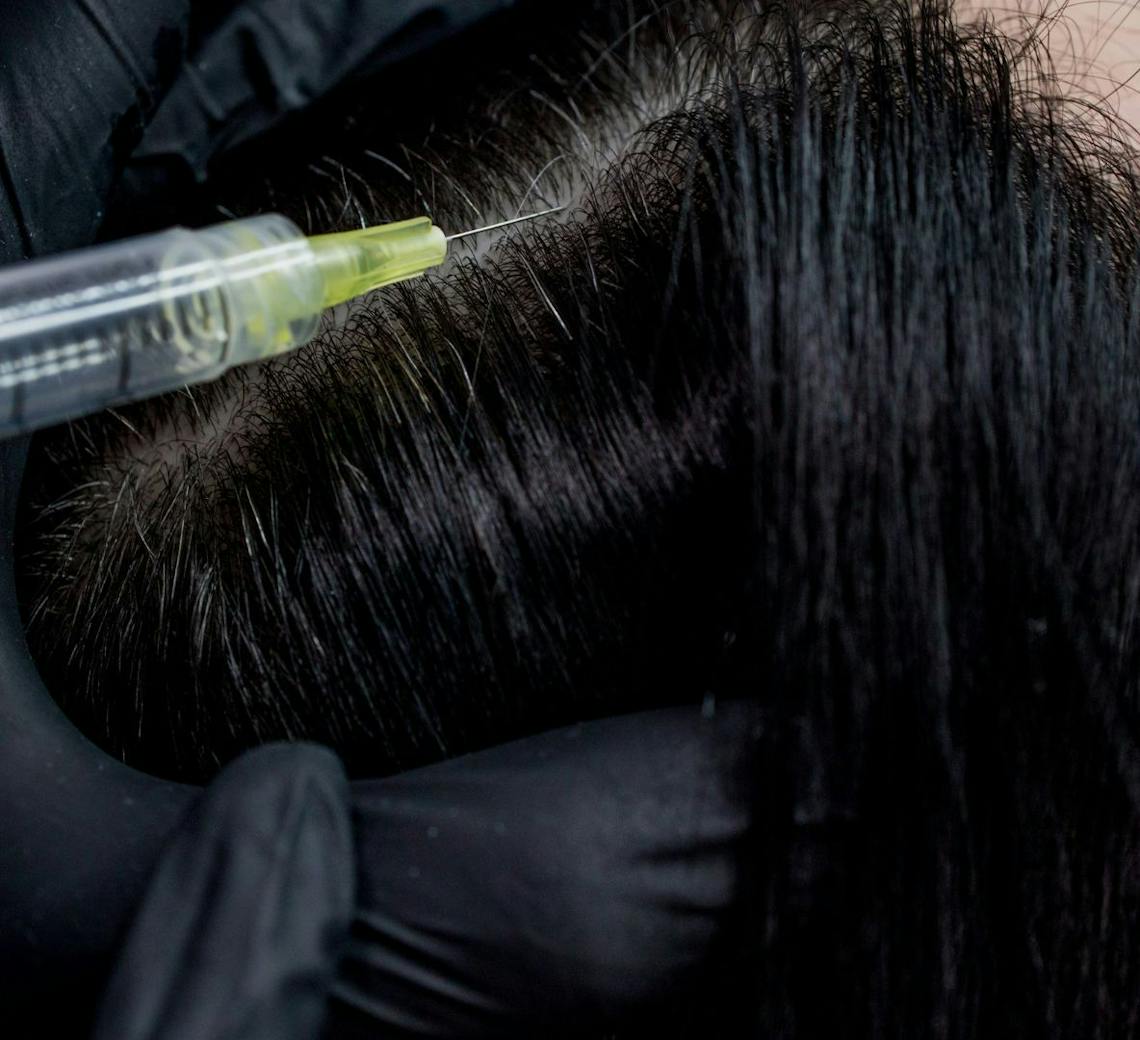 Mésothérapie capillaire : un shot de nutriments pour le cuir chevelu via des injections.
