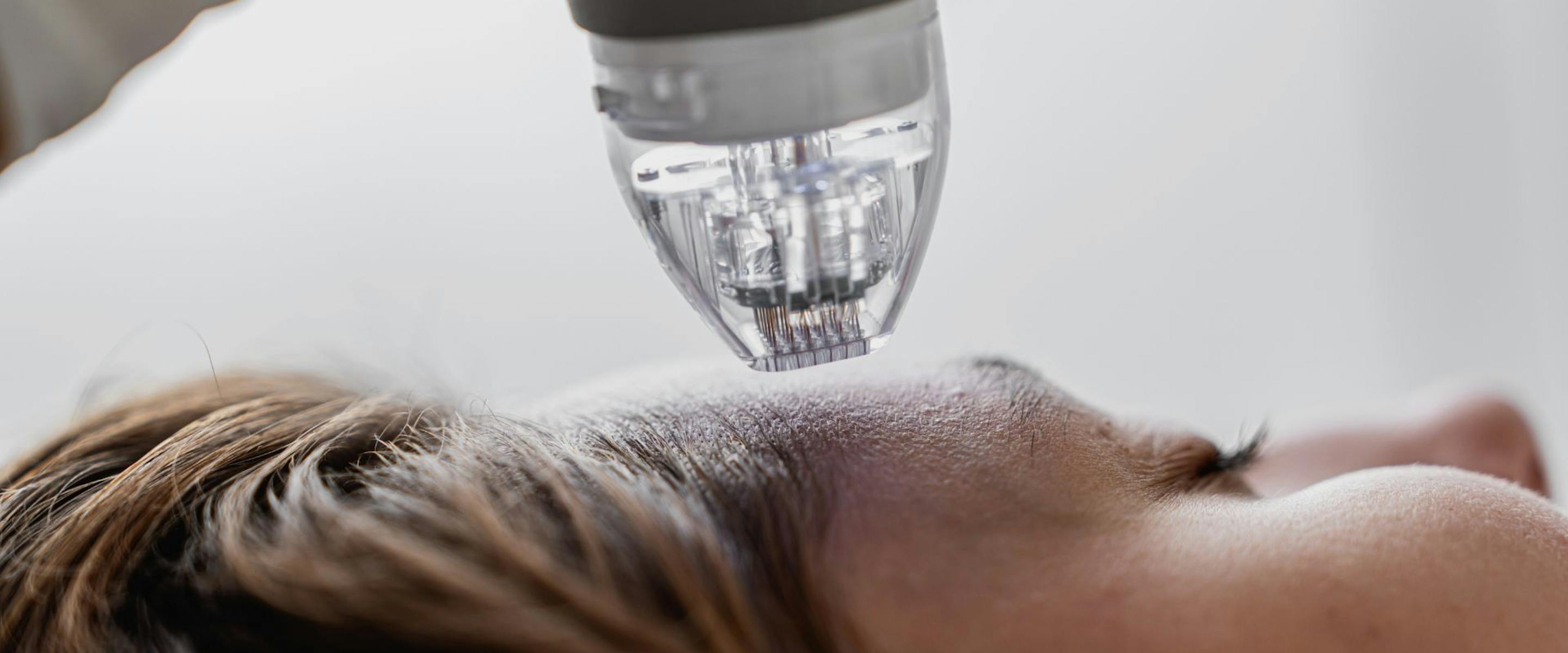 Microneedling : Tout comprendre sur cette méthode qui fait le buzz