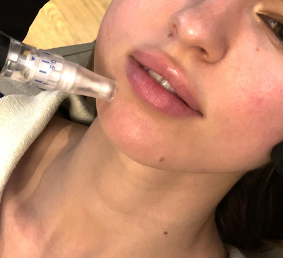 Jeune femme en pleine séance de microneedling avec un expert de chez Maison Yoko Lyon.