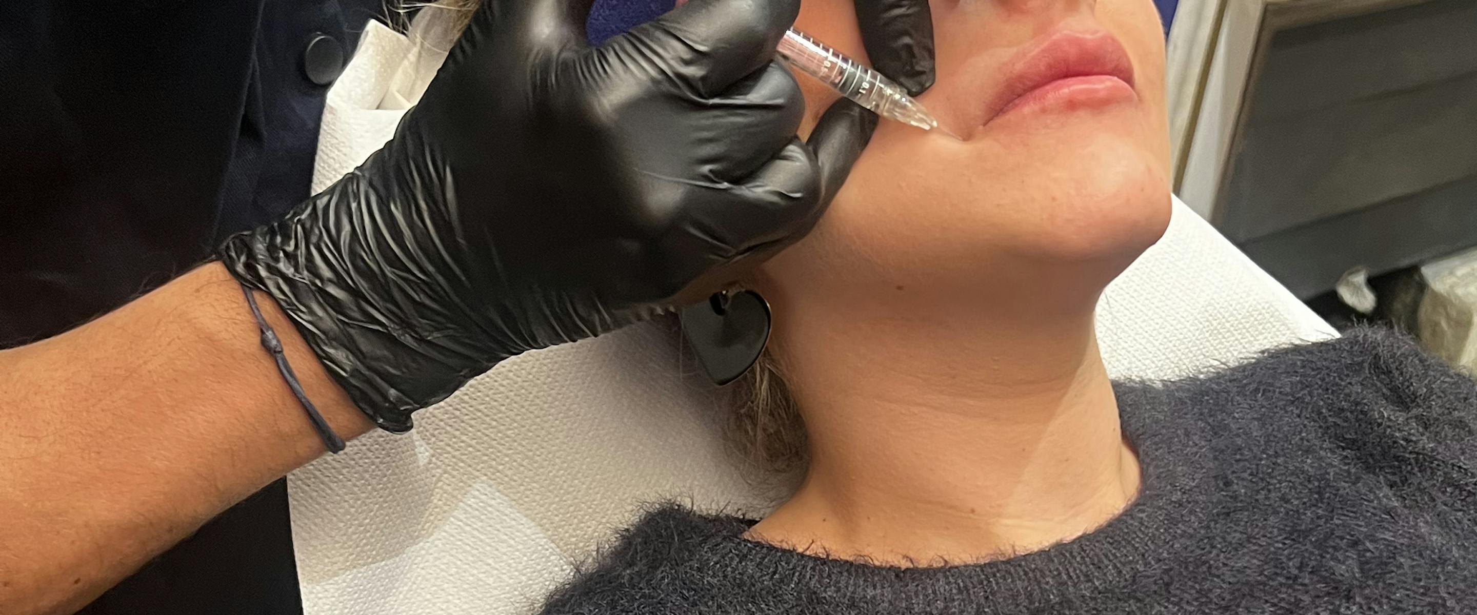 Médecin qui réalise injections d'acide hyaluronique dans le visage d'une patiente.