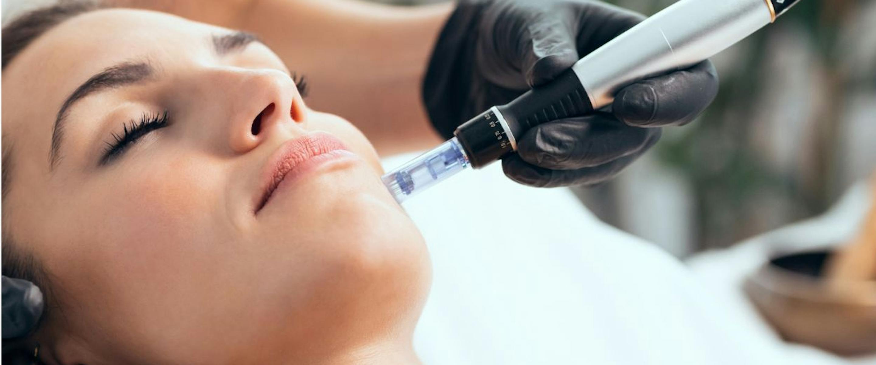 Microneedling avant/après