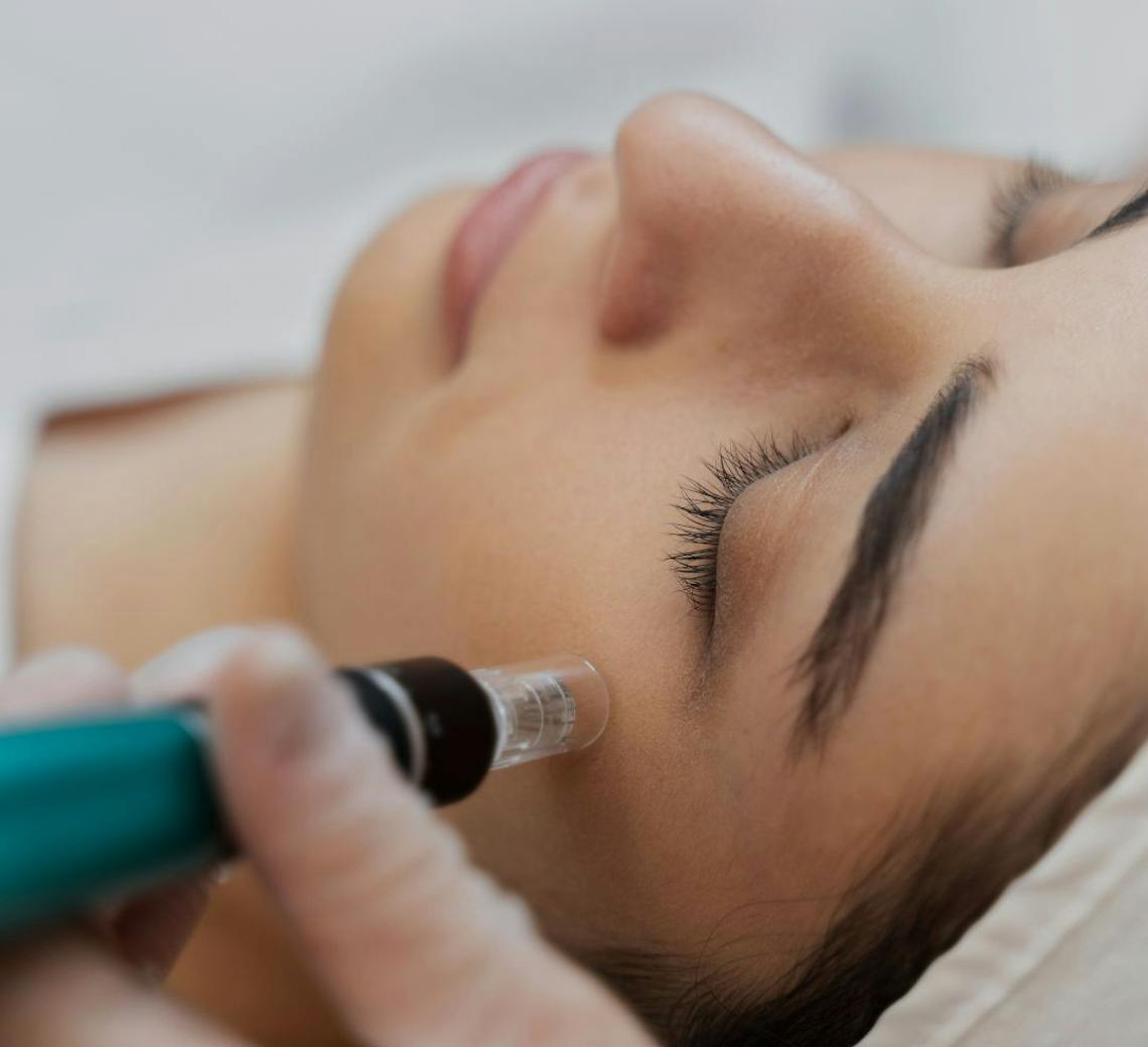 Microneedling